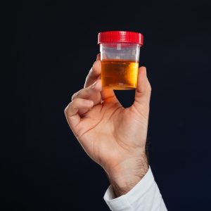 Close up of male's hand holding container with urine for urinary tract infection patient