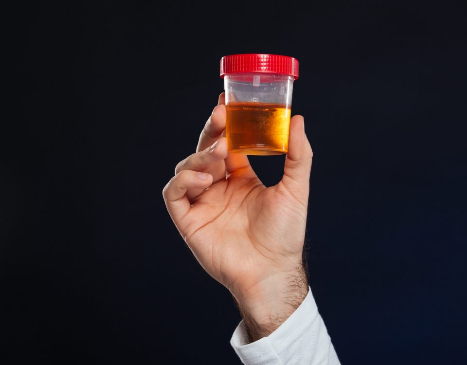 Close up of male's hand holding container with urine for urinary tract infection patient