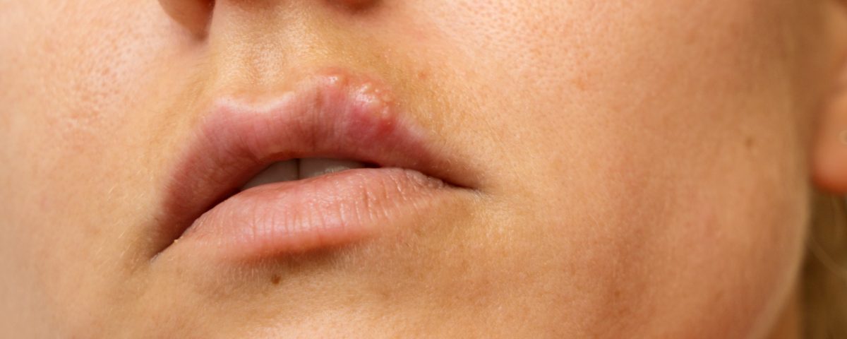 Close up woman have cold sore on her upper lip