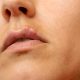 Close up woman have cold sore on her upper lip