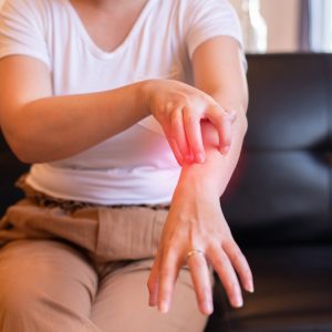 Woman with rash and scratch on her arm from urticaria